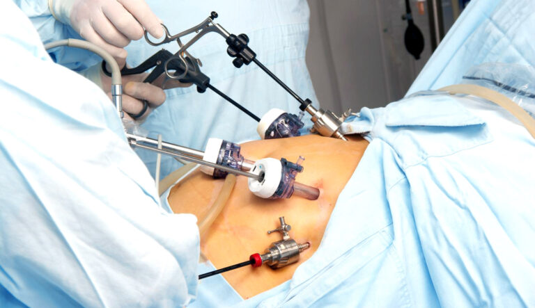 laparoscopic gastric sleeve surgery
